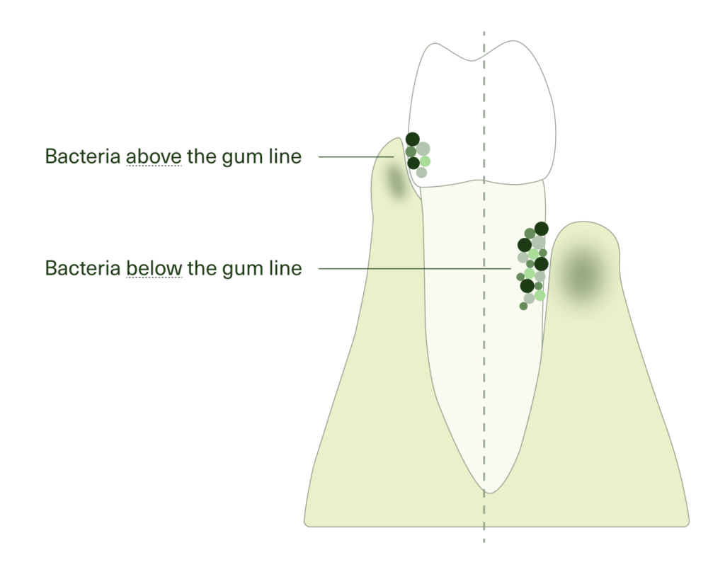 Diagram showing bacteria located above and below the gum line on a tooth and gums.