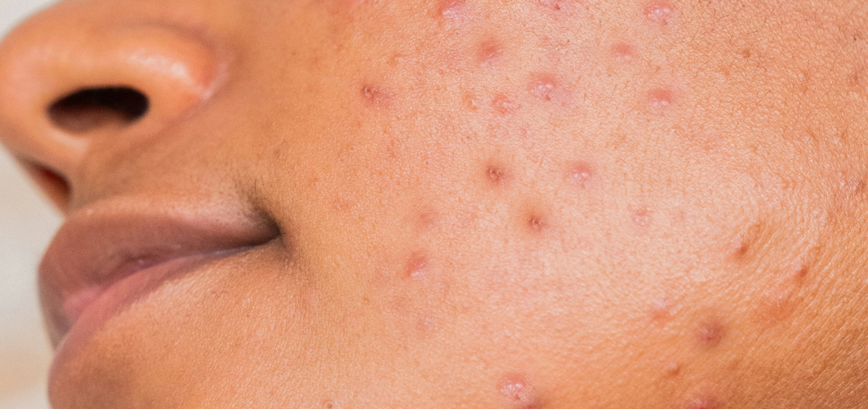 Gut Check: How Probiotics for Acne Affect the Gut-Skin Axis