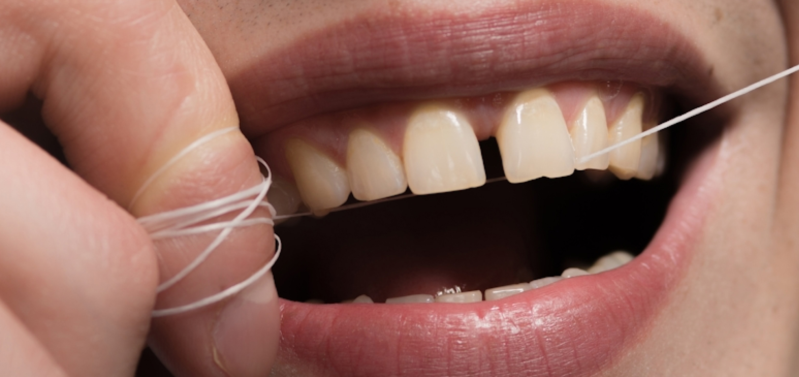 Probiotics for Oral Health: What Really Works for Your Mouth (and Why Your Gut Matters)